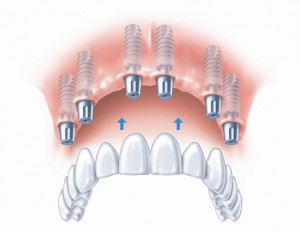 Denture supported by implants