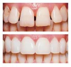 Veneers: Before and After