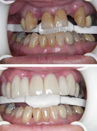 Bridges improve the appearance of adjacent teeth as well.