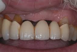 Bone loss with poor esthetic result