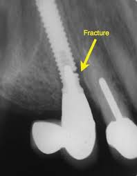 Fractured implant