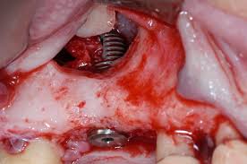 Implant in Sinus