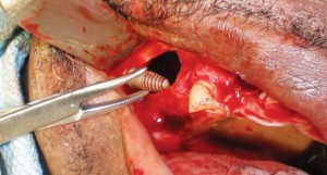 Implants displaced into the maxillary sinus