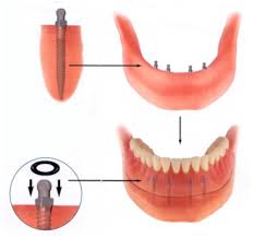 Mini Dental Implants to Support a Denture