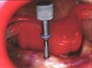 Placing the Mini Dental Implant