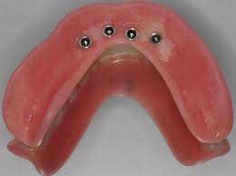 Attachments on the denture